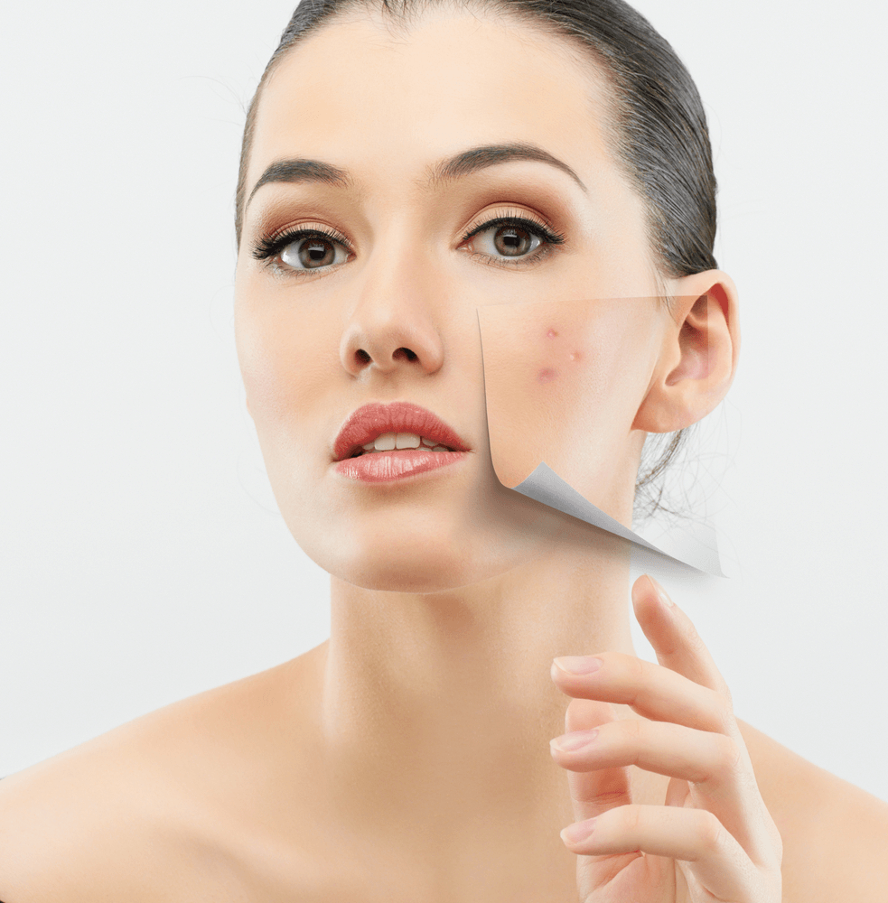 6 Persistent Myths About Acne that We Hear Every Day