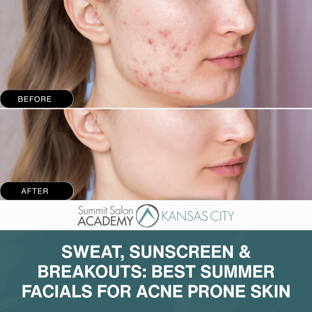 Sweat, Sunscreen & Breakouts: Best Summer Facials for Acne Prone Skin